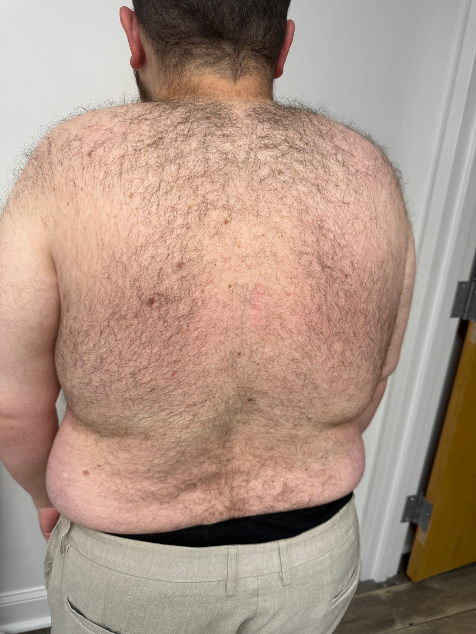 Laser Hair Removal before result