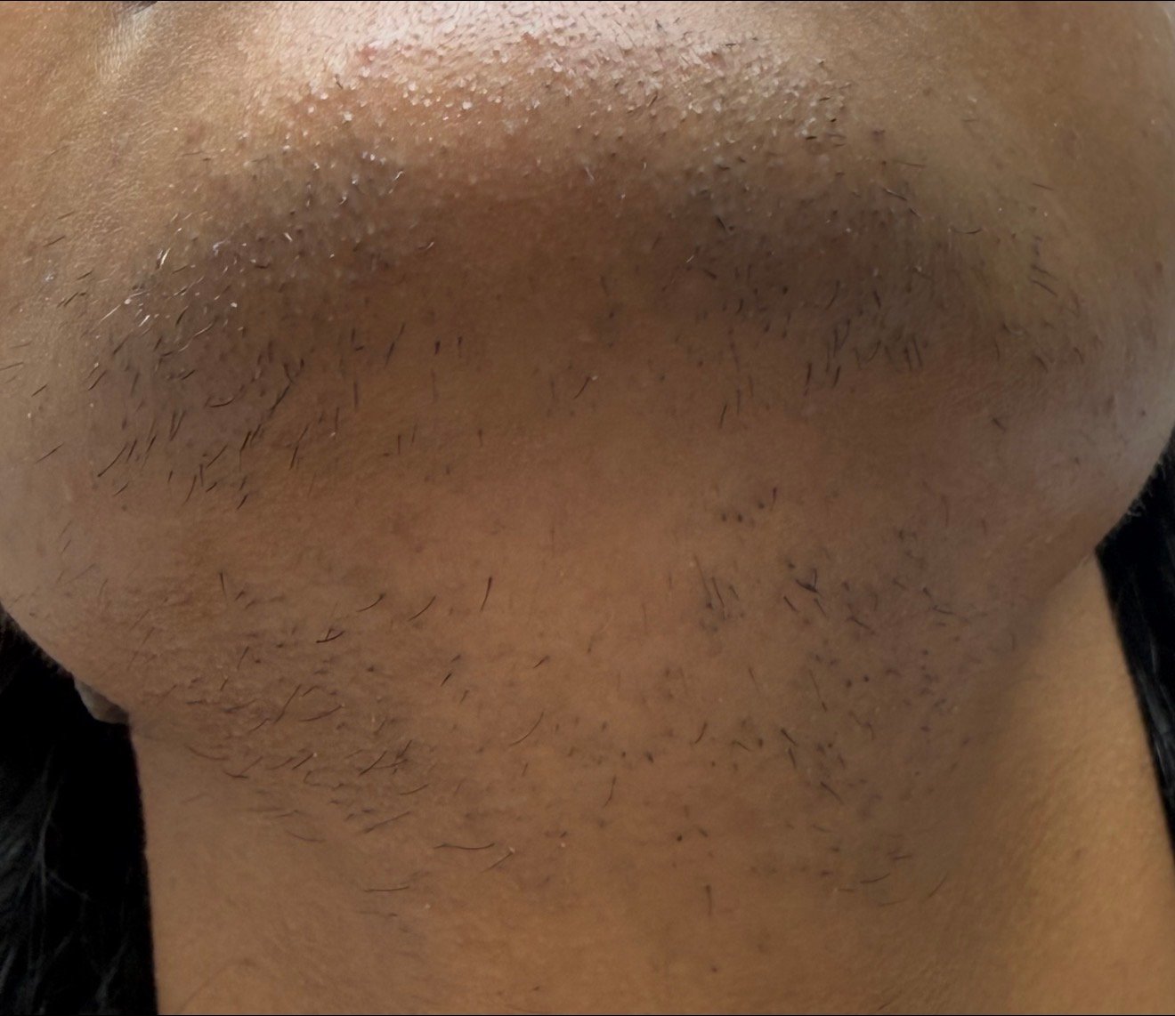 Laser Hair Removal  before result