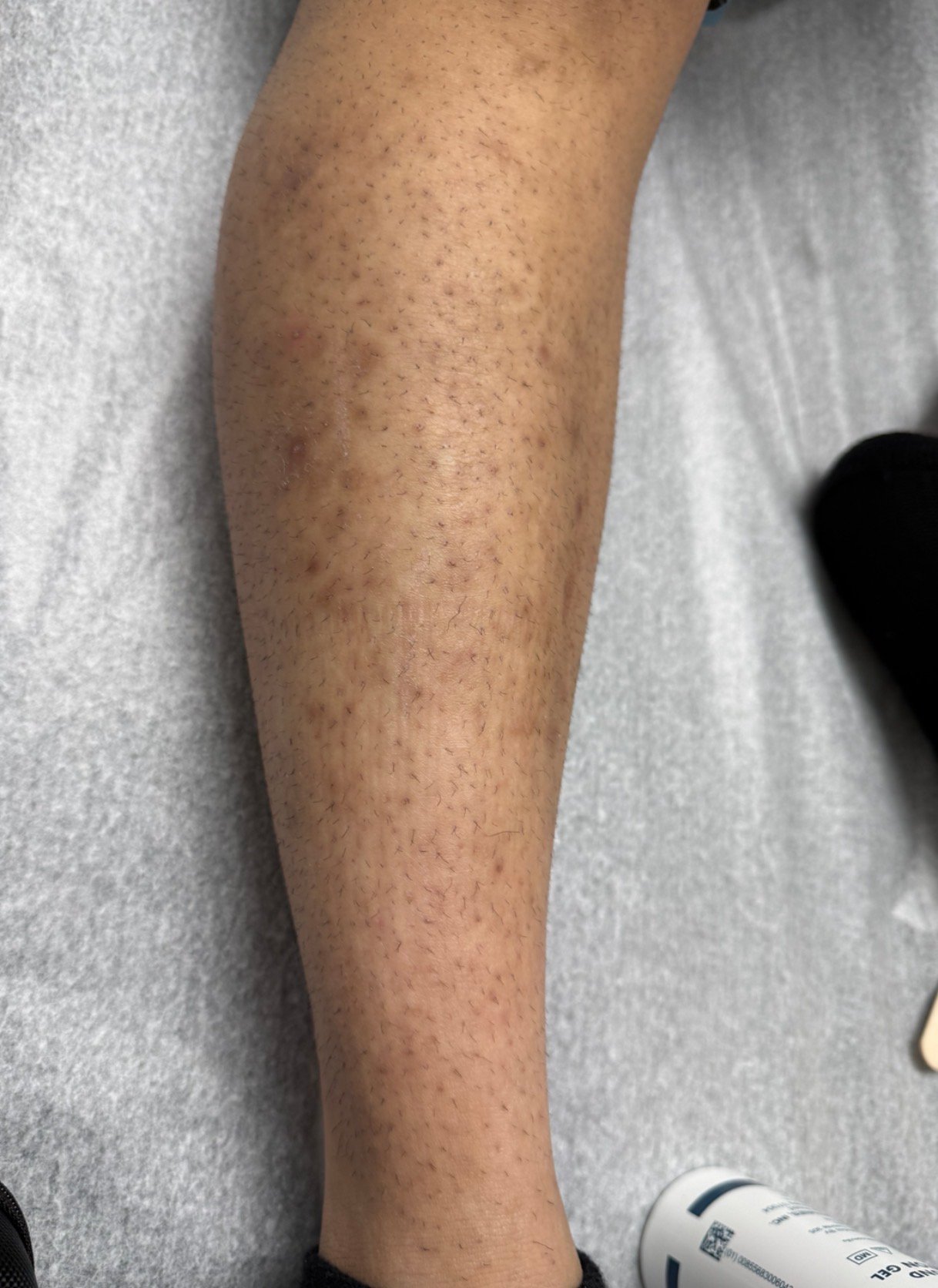 Laser Hair Removal before result