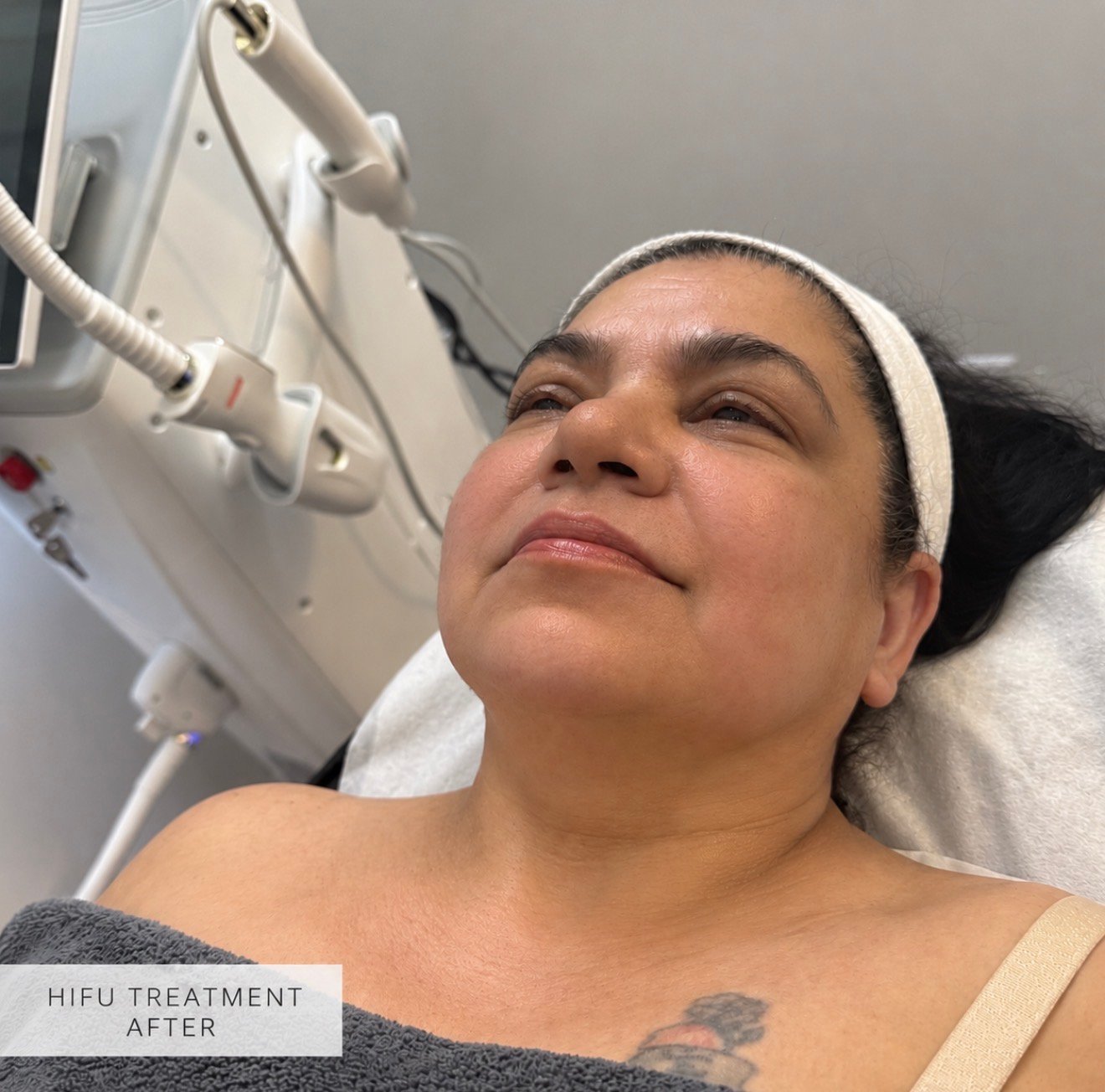 HIFU Treatment  after result