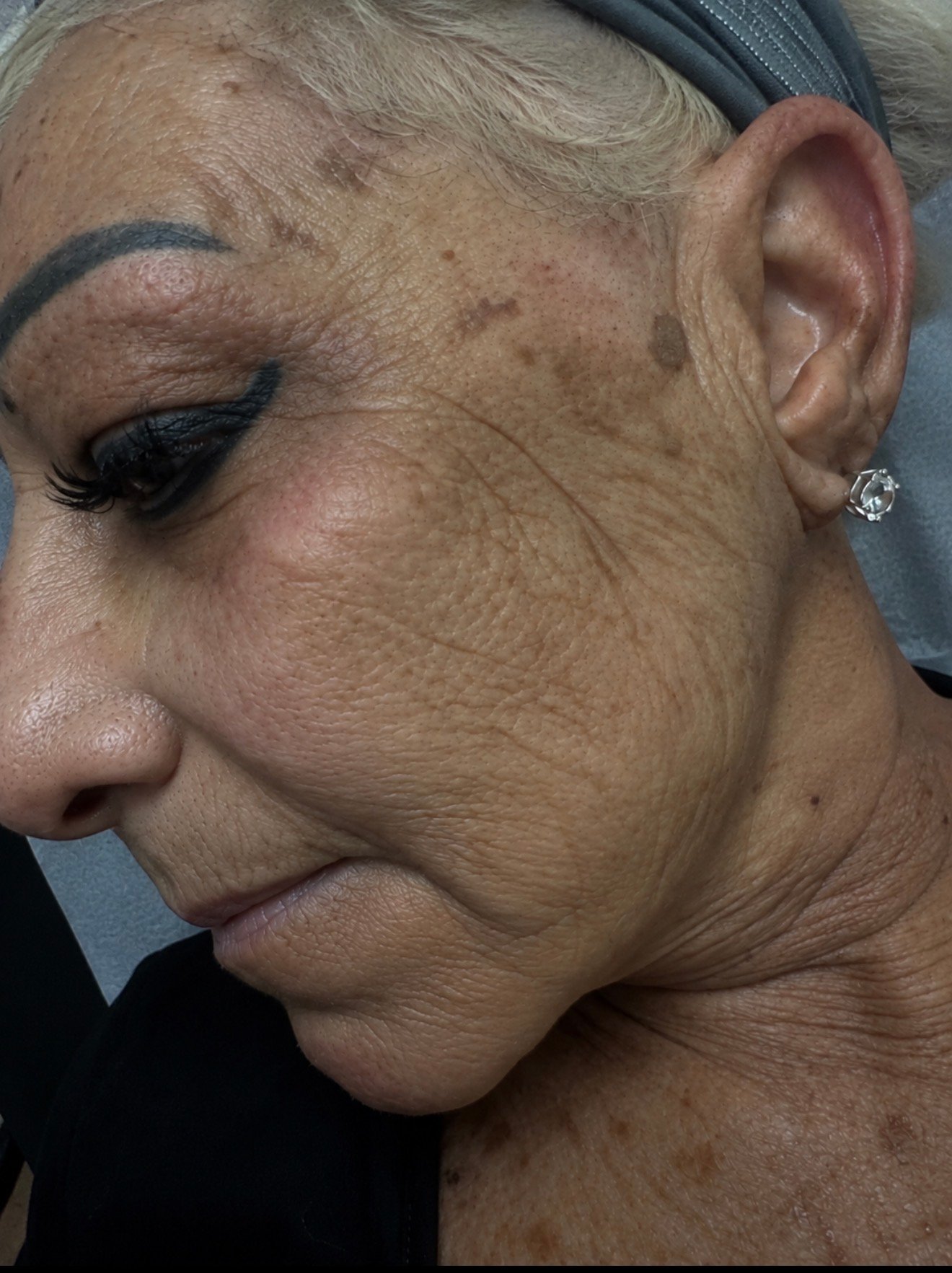 Skin Transformations before result