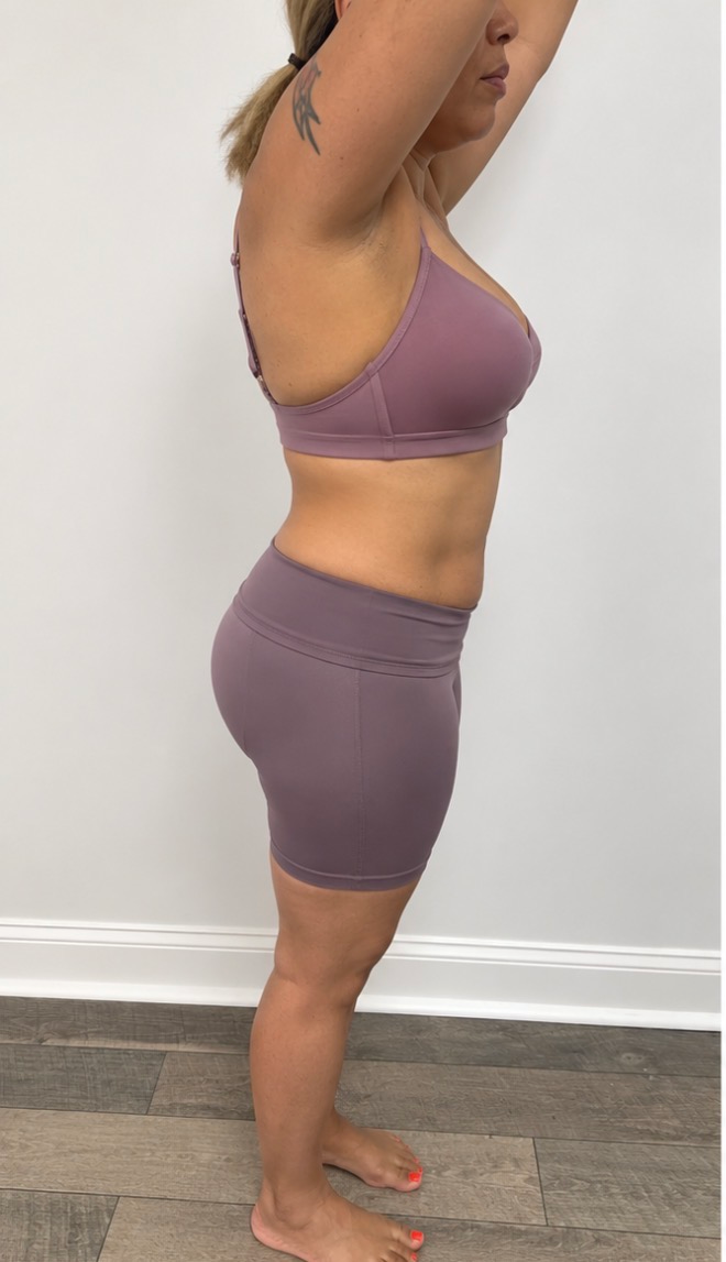 Body Contouring and Sculpting Treatments before result